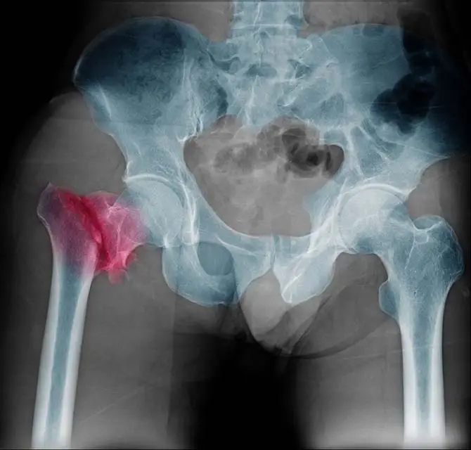 Hip Replacements and 3D Printing